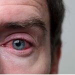 Conjunctivitis