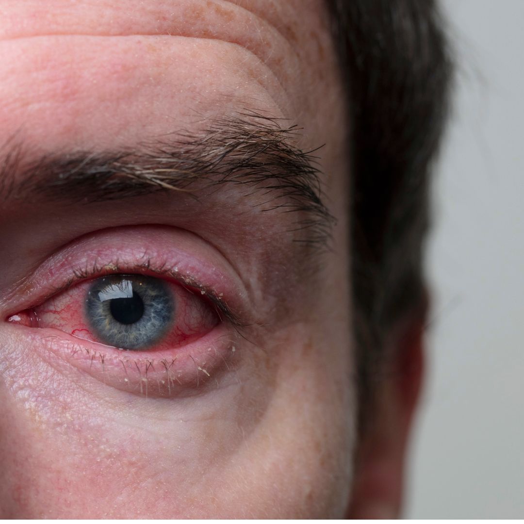 conjunctivitis-understanding-the-pink-eye-infection-ashob-e-chashm