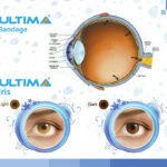 Ultima Prosthetic Iris Lens