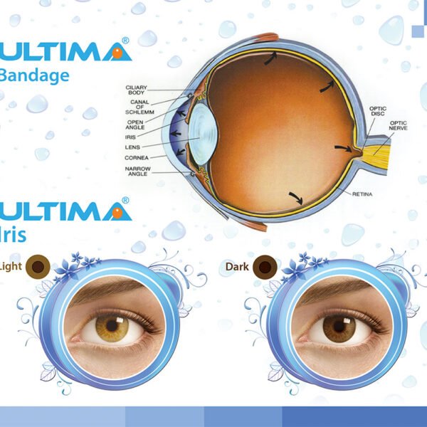 Ultima Prosthetic Iris Lens