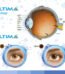 Ultima Prosthetic Iris Lens