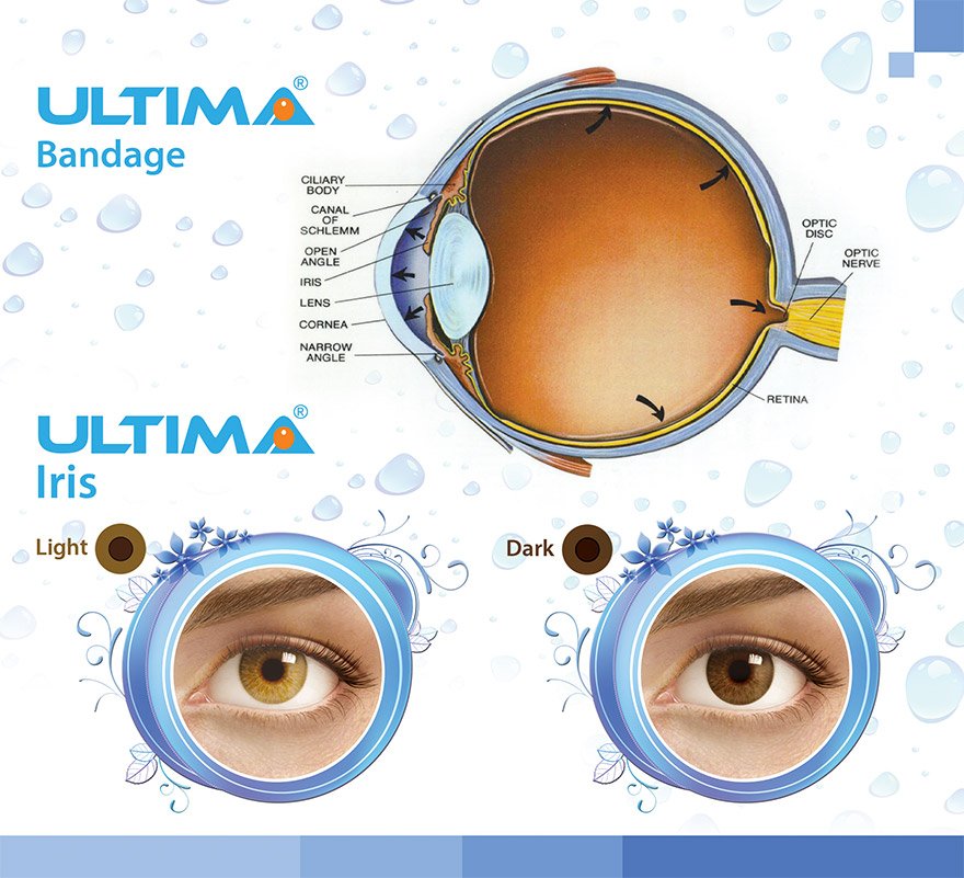Ultima Prosthetic Iris Lens Ultima Prosthetic Iris Lens
